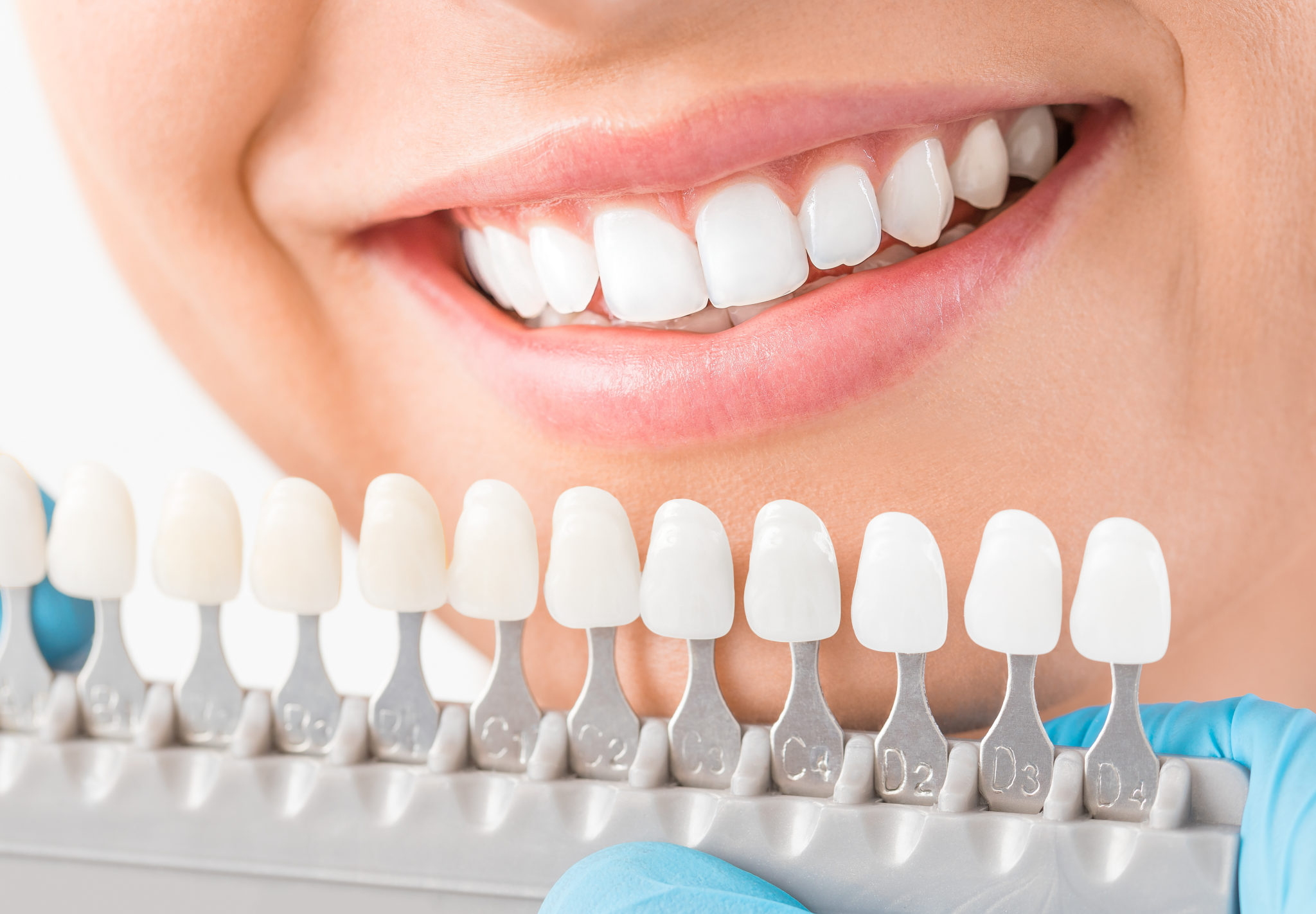 Teeth Whitening – Why It’s Better at the Dentist - Adam Dental Supplies ...