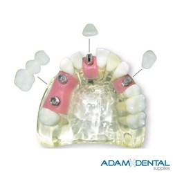 Dental Implant Dental/Education Demonstration Model