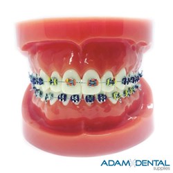 Upper And Lower Arch With Metal Brackets Dental/ Education Demonstration Models