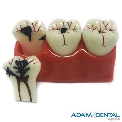 Caries Progressive Oversize Dental/Education Demonstration Models