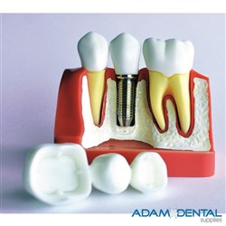 Implant & Bridge Dental Demonstration Model