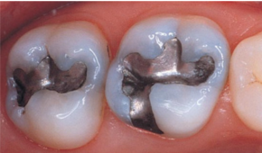 Amalgam and Alloys - Adam Dental Supplies Australia