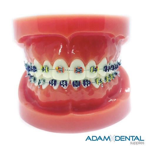 Upper And Lower Arch With Metal Brackets Dental/
