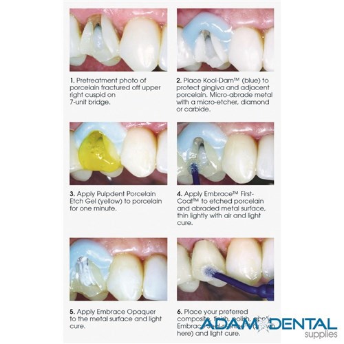 Embrace Restoration & PFM Porcelain Repair Kit