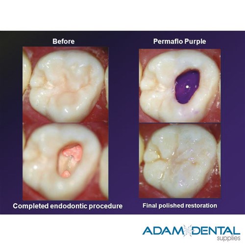 Ultradent PermaFlo Purple Syringe Coronal Seal