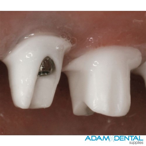 Implantlink Semi Forte Implant Cement 5ml Automix + 10 Tips